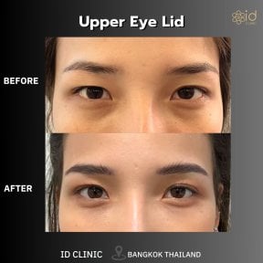 before-after photo upper-eyelid-surgery