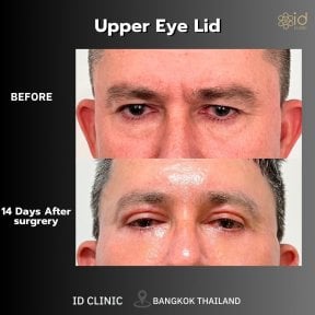 before-after photo upper-eyelid-surgery