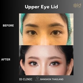 before-after photo upper-eyelid-surgery