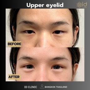 before-after photo upper-eyelid-surgery
