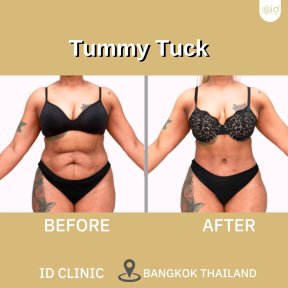 before-after photo tummy-tuck-and-liposuction