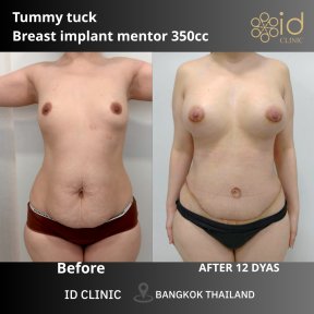 before-after photo tummy-tuck-and-liposuction
