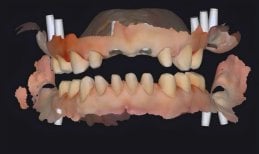 Dental implant planning scan at Punta Cana dentist odontologia familiar, digital treatment result
