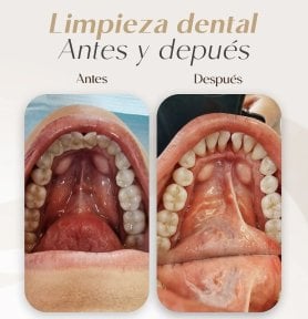 Before and after dental cleaning results at Punta Cana dentist odontologia familiar, cleaner teeth