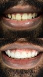 Before and after dental implant results at Punta Cana dentist odontologia familiar, improved smile