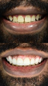 before-after photo smile-makeover