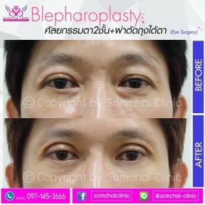 Before and after upper eyelid surgery results at Somchai Clinic, improved eye appearance