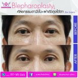 Before and after upper eyelid surgery results at Somchai Clinic, improved eye appearance