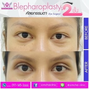 Upper eyelid surgery before and after results at Somchai Clinic, blepharoplasty improvement