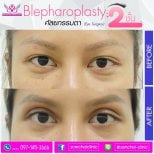 Upper eyelid surgery before and after results at Somchai Clinic, blepharoplasty improvement
