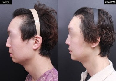 Результати до і після геніопластики у VG Plastic Surgery, покращений профіль підборіддя
