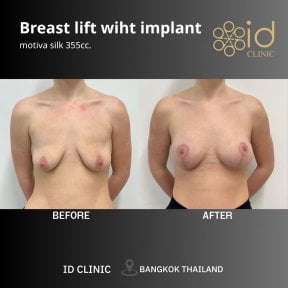 Before and after breast lift with implant results at ID Clinic Bangkok, improved breast shape
