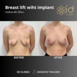 Before and after breast lift with implant results at ID Clinic Bangkok, improved breast shape