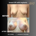 Before and after breast lift with implants at ID Clinic Bangkok, 1 month post-op results
