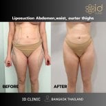 Before and after abdominal, waist, and thigh liposuction results at ID Clinic Bangkok