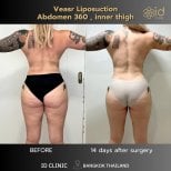 Before and after abdominal and inner thigh liposuction results at ID Clinic Bangkok