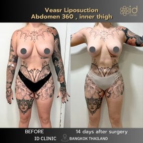 Before and after abdominal 360 and inner thigh liposuction results at ID Clinic Bangkok