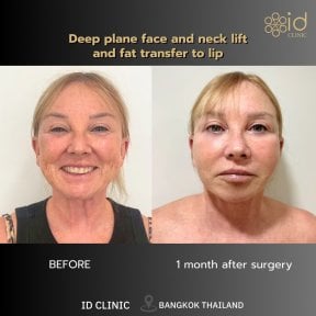 Before and after deep plane facelift and neck lift with fat transfer at ID Clinic Bangkok