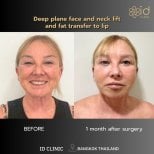Before and after deep plane facelift and neck lift with fat transfer at ID Clinic Bangkok