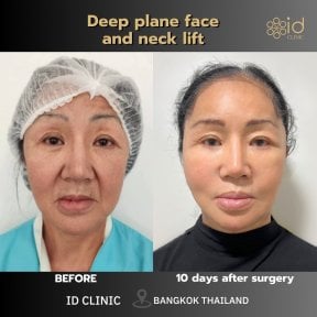 Before and after deep plane facelift and neck lift results at ID Clinic Bangkok, 10 days post-op