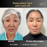 Before and after deep plane facelift and neck lift results at ID Clinic Bangkok, 10 days post-op