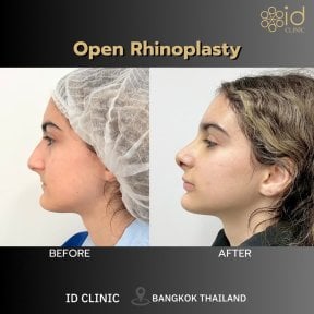 before-after photo rinoplastika-plastika-nosa