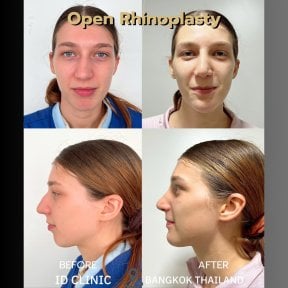 before-after photo rinoplastika-plastika-nosa