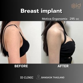 before-after photo breast-augmentation