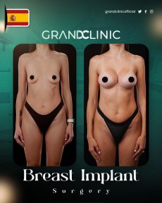 before-after photo vaser-liposuction