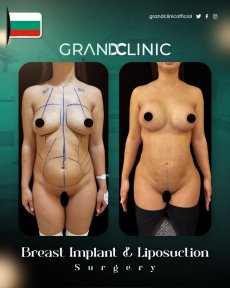 before-after photo vaser-liposuction