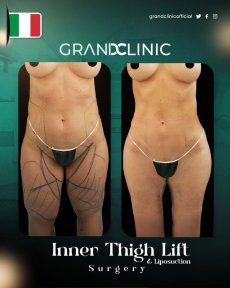 before-after photo vaser-liposuction
