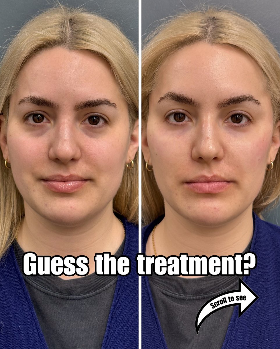 Resultados de microneedling antes y después: mejora de textura y tono facial