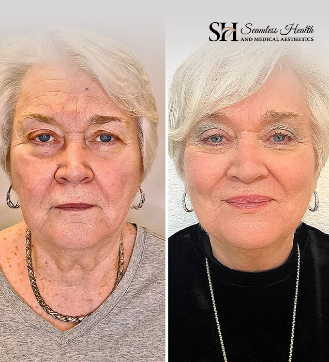 Resultados antes y después de botox para arrugas en Seamless Health, rejuvenecimiento facial visible