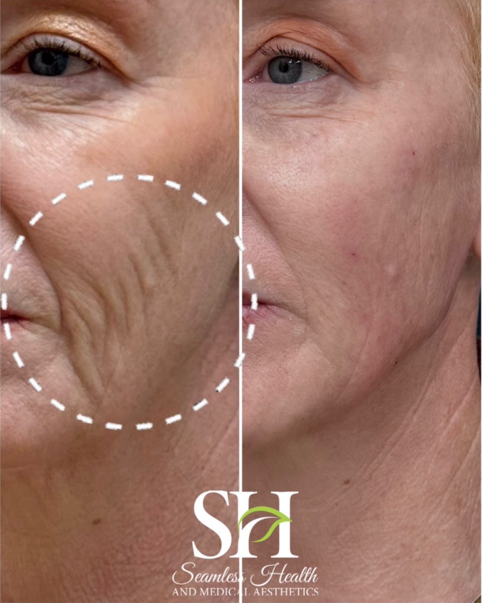 Resultados de botox para arrugas antes y después en Seamless Health, piel facial más lisa