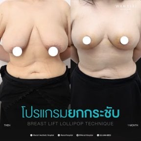 before-after photo breast-augmentation
