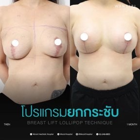 before-after photo breast-augmentation