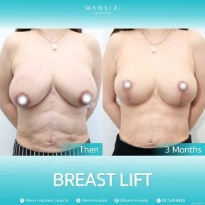 before-after photo breast-augmentation