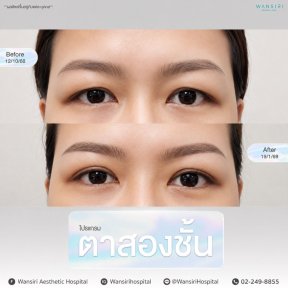 Resultados de blefaroplastia antes y después en Wansiri Hospital, corrección de párpados