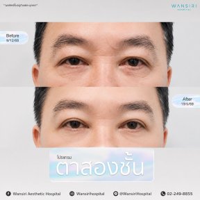 Resultados de blefaroplastia antes y después en Wansiri Hospital, corrección de párpados