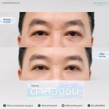 Resultados de blefaroplastia antes y después en Wansiri Hospital, corrección de párpados