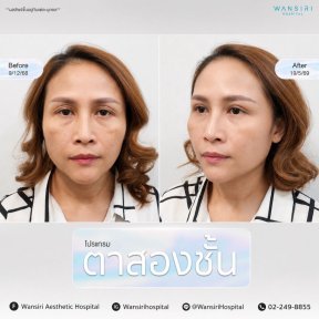 Resultados de blefaroplastia antes y después en Wansiri Hospital, mejora de párpados