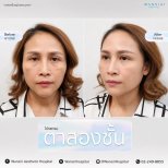 Resultados de blefaroplastia antes y después en Wansiri Hospital, mejora de párpados