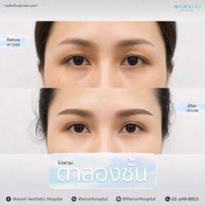 Resultados de blefaroplastia antes y después en Wansiri Hospital, mejora de párpados