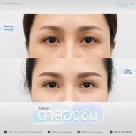 Resultados de blefaroplastia antes y después en Wansiri Hospital, mejora de párpados