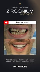 before-after photo dental-crown-installation