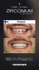 before-after photo dental-crown-installation