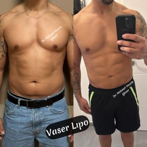 Resultados antes y después de Vaser lipo con Dr. Mehmet Haşim Güner, abdomen definido
