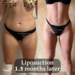 Resultados de liposucción antes y después por Dr. Mehmet Haşim Güner, 1,5 meses