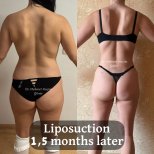 Resultados de liposucción antes y después con Dr. Mehmet Haşim Güner, cambio en 1,5 meses