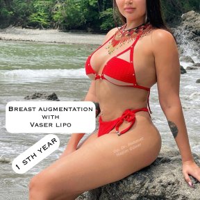 before-after photo breast-augmentation